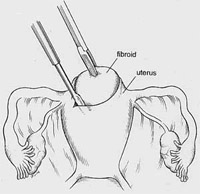 Laparoscopic Myomectomy